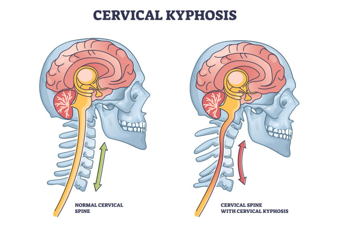 Sunset Chiropractic Wellness Review Incidencia De Cifosis Cervical Y
