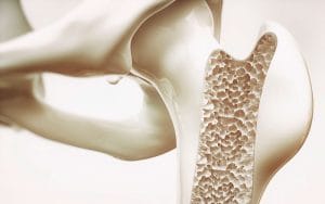 Osteoporosis - spinal kyphosis on gastric myoelectrical