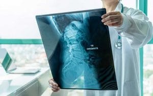 Symptoms of Spinal Stenosis - Spinal Stenosis