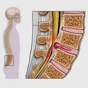 Conditions - Spinal Stenosis Conditions - Spinal Stenosis