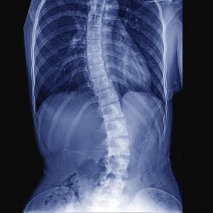 Conditions - Scoliosis Conditions - Scoliosis