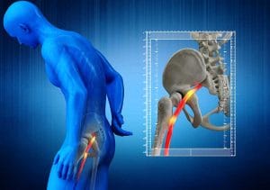 Chiropractic for Sciatica - Chiropractic for Sciatica
