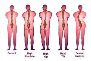 Sunset Chiropractic & Wellness Research Review: Association Between Incorrect Posture and Scoliosis - Association Between Incorrect Posture and Adolescent Idiopathic Scoliosis Among Chinese Adolescents