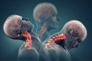 The Best Test For Cervical Ligament Instability? DMX? - The Best Test For Cervical Ligament Instability? DMX?