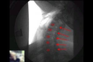 Digital Motion X-ray: Advanced Technology to Detect Ligament Injuries and Understand Spinal Biomechanics. - Digital Motion X-ray: Advanced Technology to Detect Ligament Injuries and Understand Spinal Biomechanics.