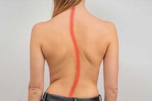 Top Scoliosis Facts 2022 - Scoliosis Facts
