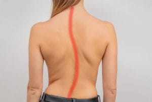 recognition of thoracic hypokyphosis and therapeutic implications - Sunset Chiropractic & Wellness Research Review
