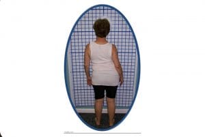 Scoliosis Treatment...No Bracing No Surgery…Finding a Better Way - Scoliosis is more than a Cobb angle.