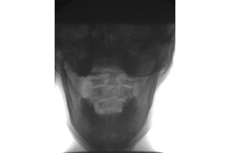 Lesiones de ligamentos mal diagnosticadas más comunes en el cuello (AKA) Inestabilidad y lesión cervical - Lesiones de ligamentos mal diagnosticadas