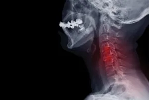 Sunset Chiropractic & Wellness Research Review: Biomechanical effect of C5-C6 intervertebral disc degeneration on the human lower cervical spine (C3-C7): a finite element study.In this study, the biomechanical effects of a progressively degenerated C5-C6 segment on the human lower cervical spine are determined by a detailed simulation of intervertebral disc degeneration