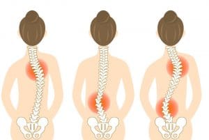 Top 8 Scoliosis Facts 2022-Scoliosis is the leading orthopedic problem seen in school age children