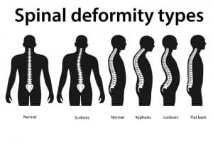 Sunset Chiropractic & Wellness Research Review: Cervical spine alignment, sagittal deformity, and clinical implications: a review. This paper is a narrative review of normal cervical alignment, methods for quantifying alignment
