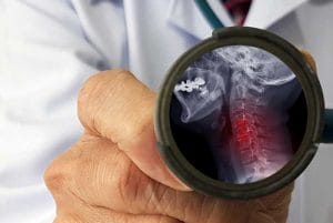Does cranial incidence angle have a role in the tendency toward cervical degenerative disc disease? A reverse correlation between cranial incidence angle and cervical degenerative disc disease development is demonstrated.