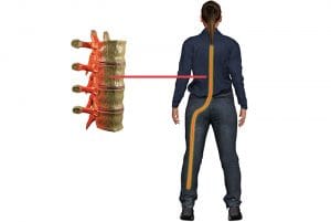 Sunset Chiropractic & Wellness Research Review: Does Improvement towards a Normal Cervical Sagittal Configuration Aid in the Management of Lumbosacral Radiculopathy: A Randomized Controlled Trial. A randomized controlled study with a six-month follow-up was conducted to investigate the effects of sagittal head posture correction on 3D spinal posture parameters, back and leg pain, disability, and S1 nerve root function in patients with chronic discogenic lumbosacral radiculopathy (CDLR).
