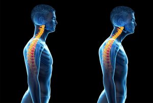 Sunset Chiropractic & Wellness Research Review: Cervical spine alignment,  sagittal deformity, and clinical implications: a review – Sunset  Chiropractic & Wellness – Miami Scoliosis Chiropractors