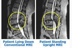Sunset Chiropractic & Wellness Research Review: Magnetic Resonance Imaging Evaluation of Biomechanical Effects of Axial Loading on the Lumbar Spine. : MRI techniques of the lumbar spine have not provided data on the effect of gravity on the spine and on the relationship of anatomic structures during its action.