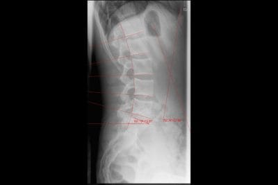 Sunset Chiropractic & Wellness. Unique Diagnosis and Treatment System. We utilize sitting x-rays because it puts 50% more stress load on the spinal structures and allows us to identify and diagnose spinal system damage and failures that do not show up in recumbent MRI and CT scan or standing x-ray.