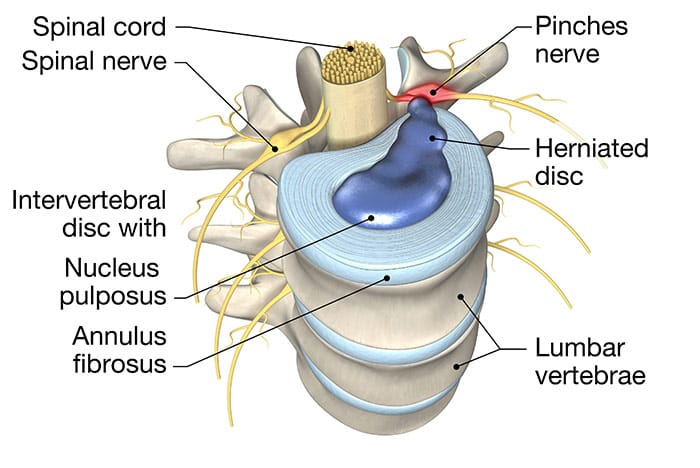 Sunset Chiropractic and Wellness. ¿Los discos espinales no tienen suministro de sangre? El disco espinal es una estructura crucial en la columna vertebral que brinda soporte, flexibilidad y absorción de impactos a la columna vertebral. Se compone de dos partes, el anillo fibroso, que es la capa externa resistente, y el núcleo pulposo, que es el núcleo interno similar a un gel.