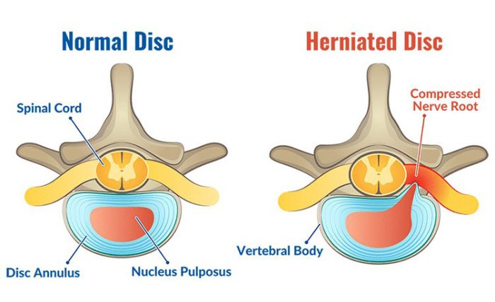 Spinal Discs Have No Blood Supply? – Sunset Chiropractic & Wellness ...