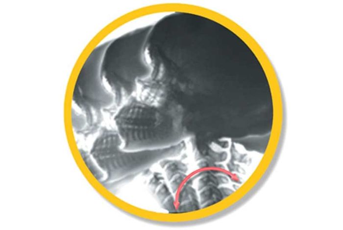 Digital Motion X-ray Identifies Injuries Missed by Motionless (X-ray, MRI, and CT ).Digital Motion X-ray (DMX) is a diagnostic tool that uses high-speed x-ray imaging to capture images of the body in motion.
