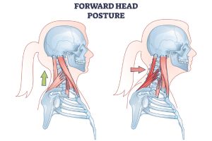 Dolor de cabeza de origen cervical - Prolive