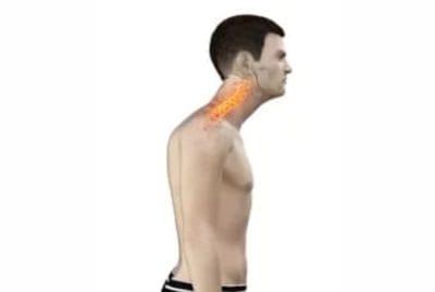 Sunset Chiropractic and Wellness.Los efectos negativos de la postura de la cabeza hacia adelante sobre la capacidad pulmonar. FHP puede ser causado por una serie de factores, que incluyen estar sentado por mucho tiempo, malos hábitos posturales y músculos del cuello débiles.